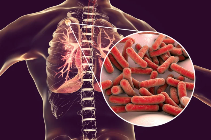 Is Tuberculosis Curable?