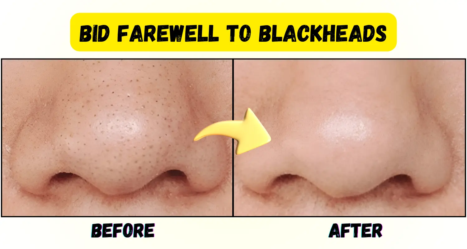 Step-by-Step Guide to Popping Blackheads